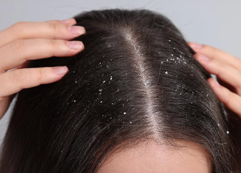 hair_dandruff