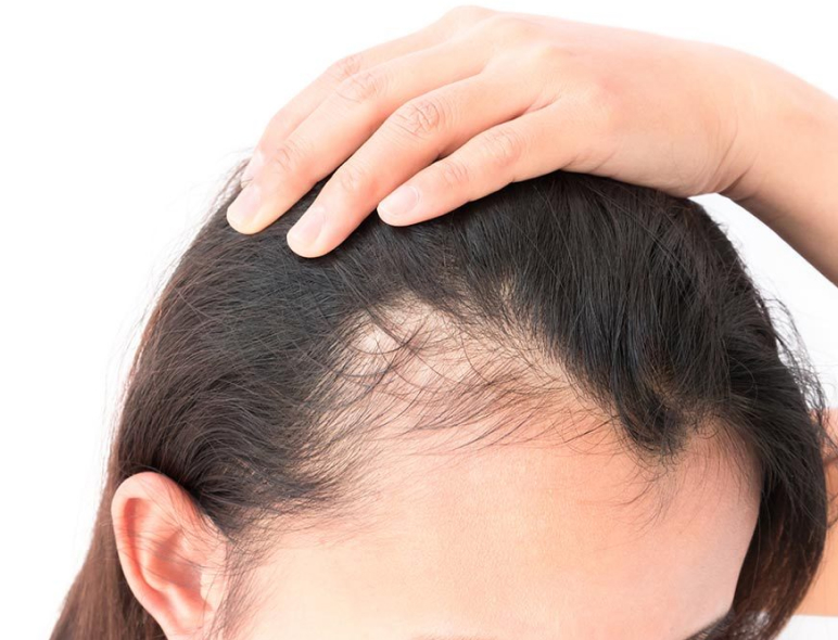 hair_thinning